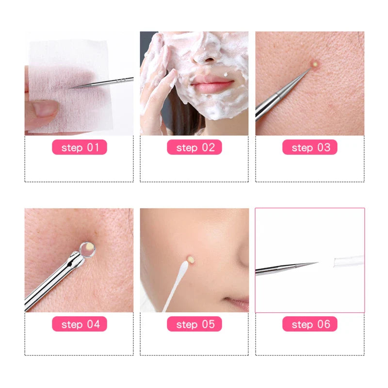 Povei Blackhead Acne Pimple Extractor Remover Stainless Steel Needles Face Skin Care