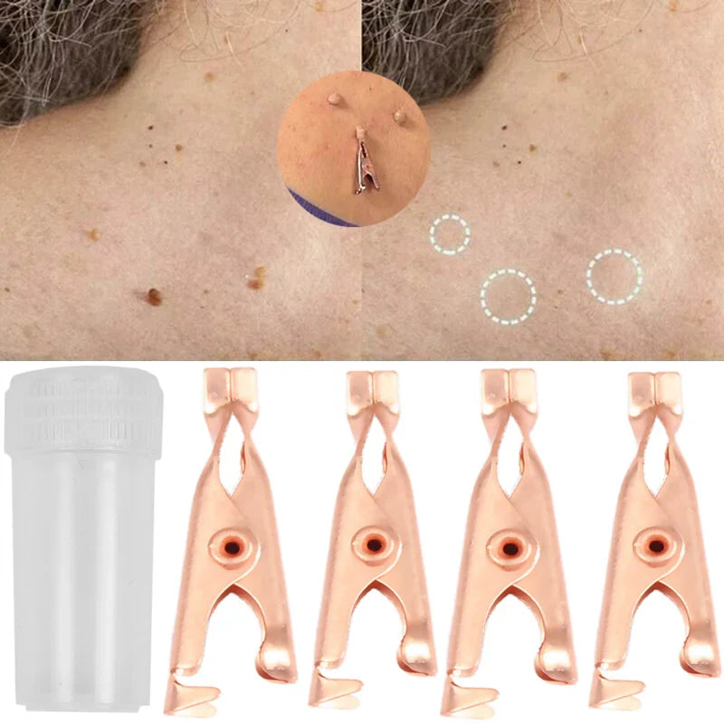 Povei Copper Tag Remover Kit for Skin Care and Wart Removal