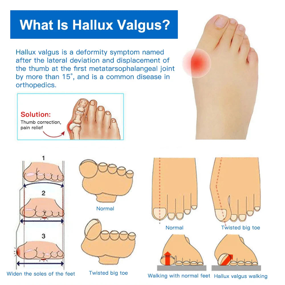 Povei Silicone Toe Separators: Bunion Corrector & Valgus Adjuster for Perfect Toe Alignment