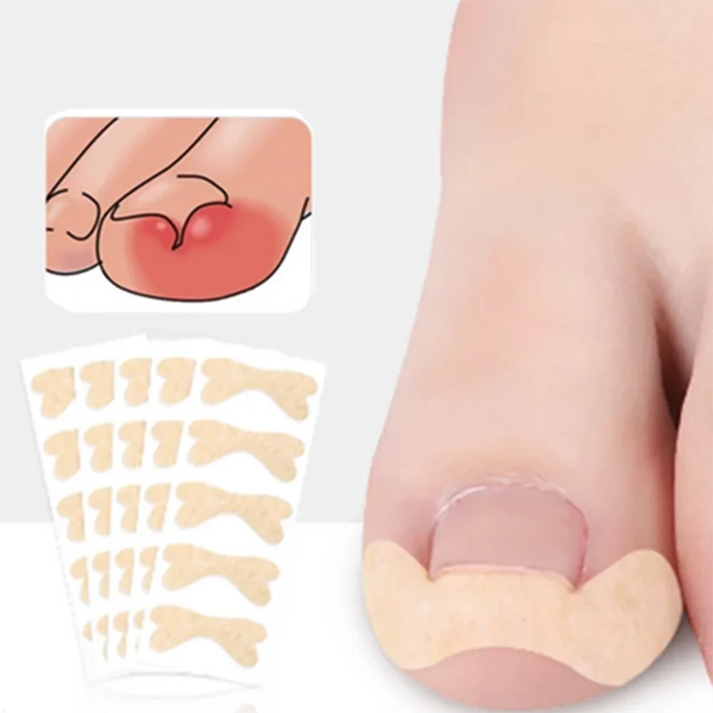 Ingrown Nail Corrector Patches by Povei: Paronychia Treatment Stickers