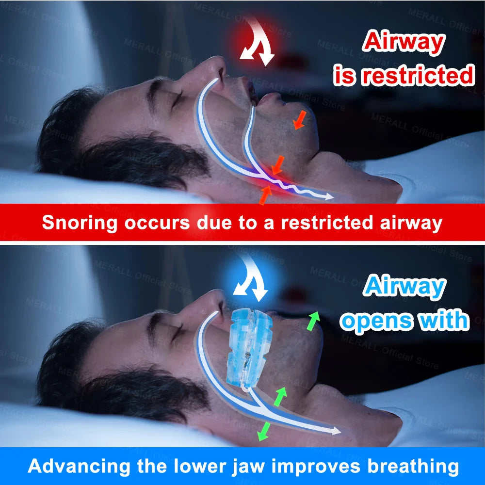 Povei Adjustable Anti Snoring Mouthpiece for Better Sleep