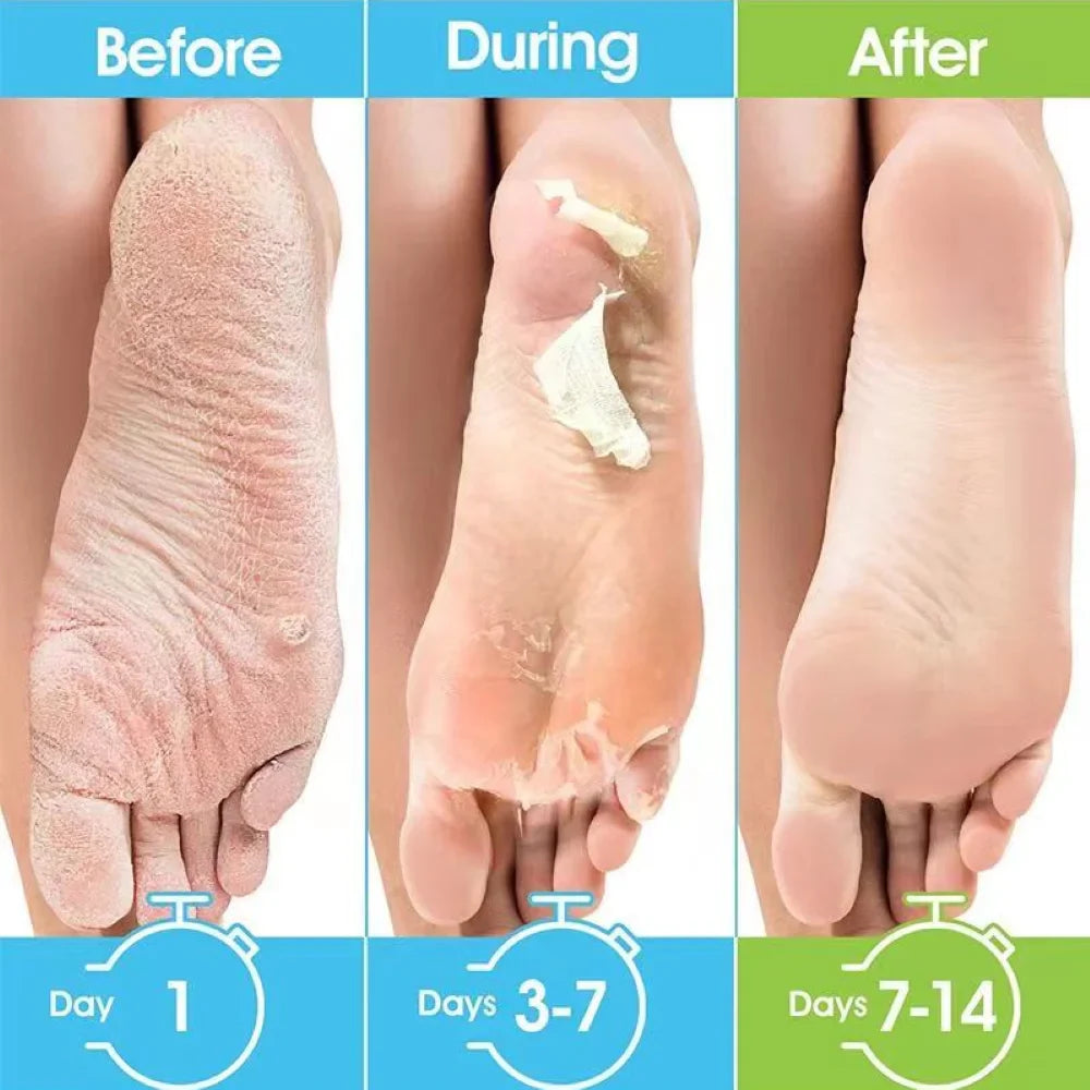 Povei Exfoliating Foot Mask for Soft Feet and Eliminating Dead Skin