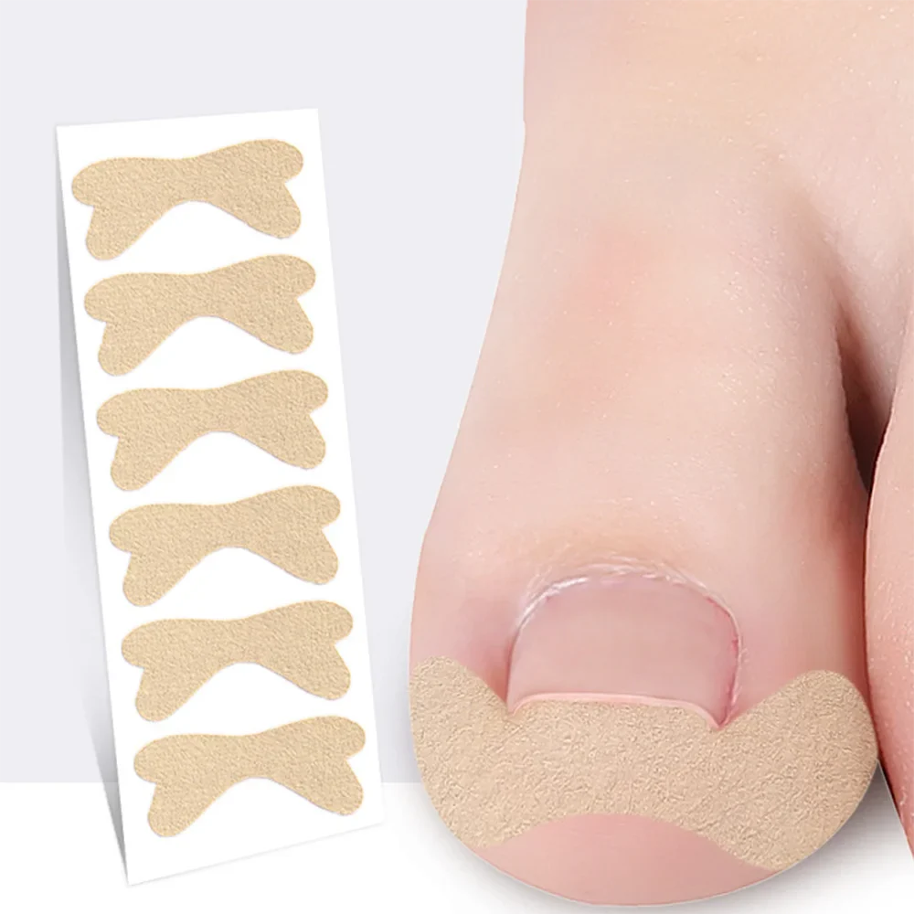 Ingrown Nail Corrector Patches by Povei: Paronychia Treatment Stickers