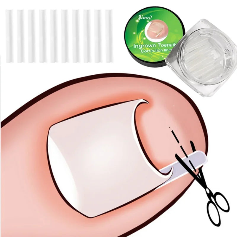 Povei Ingrown Toenail Correction Kit For Straightening Toe Nails