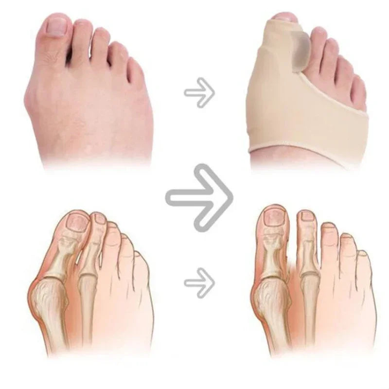 Povei Bunion Corrector Toe Separator Hallux Valgus Orthotics Straightener