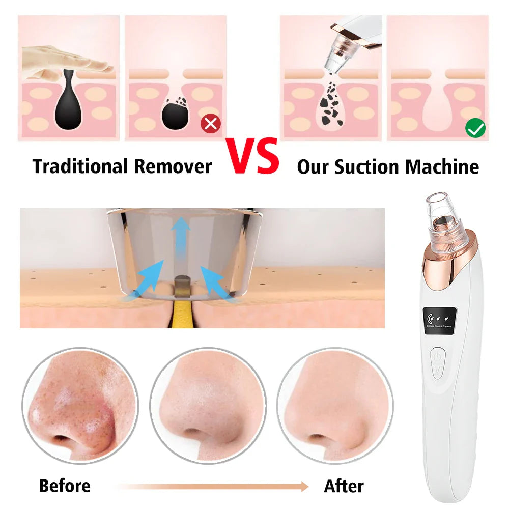 Povei Electric Blackhead Remover Vacuum for Deep Facial Pore Cleansing