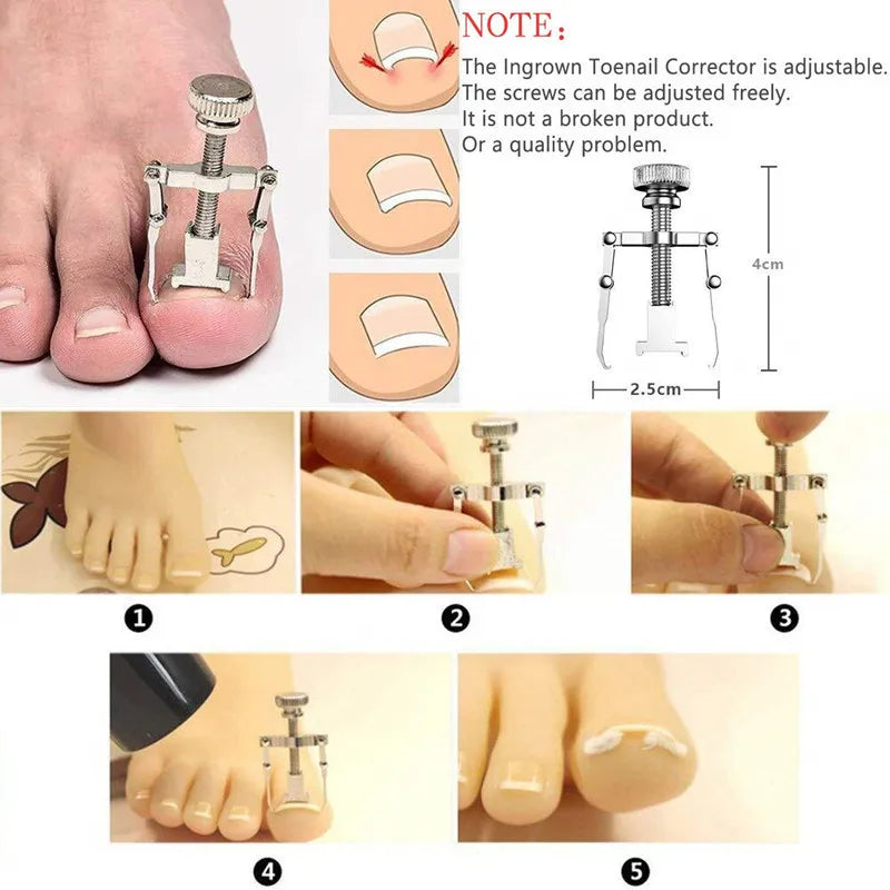 Povei Toe Nail Correction Bracket for Paronychia Treatment and Care with Fixator