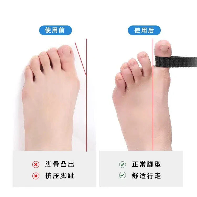 Povei Spring Toe Separator Bunion Corrector Orthotics for Hallux Valgus