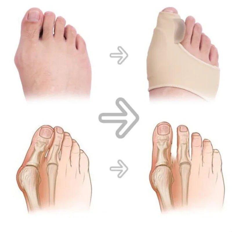 Povei Bunion Corrector Toe Separator Orthotics for Hallux Valgus - Straightener & Adjuster