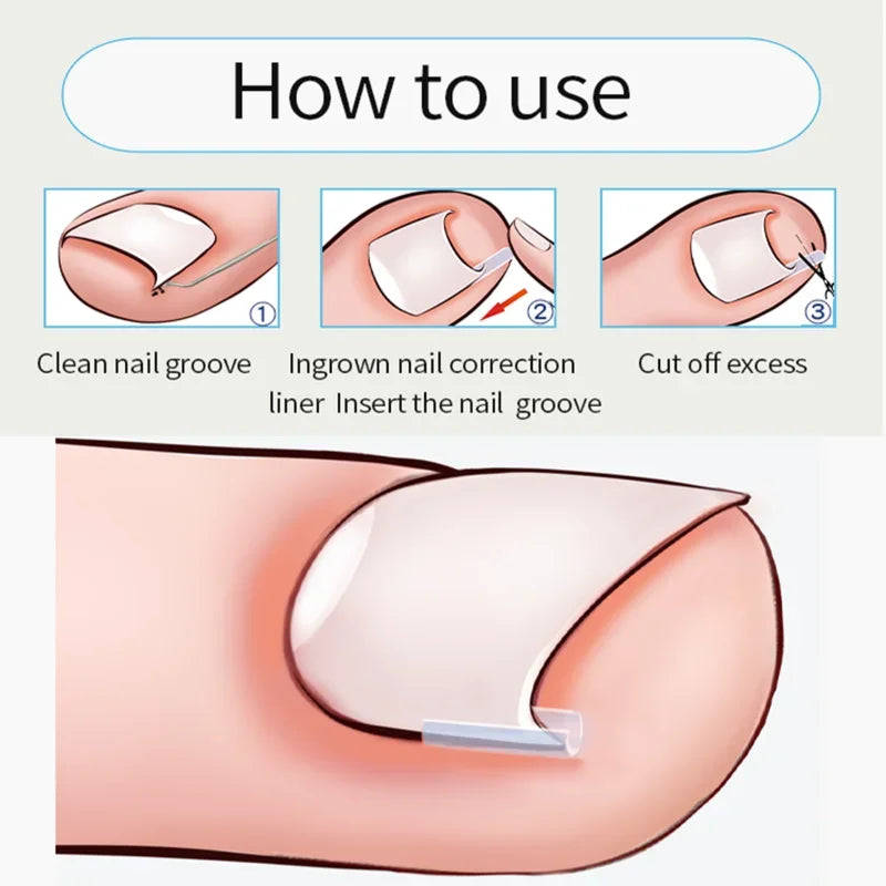 Povei Ingrown Toenail Correction Kit For Straightening Toe Nails