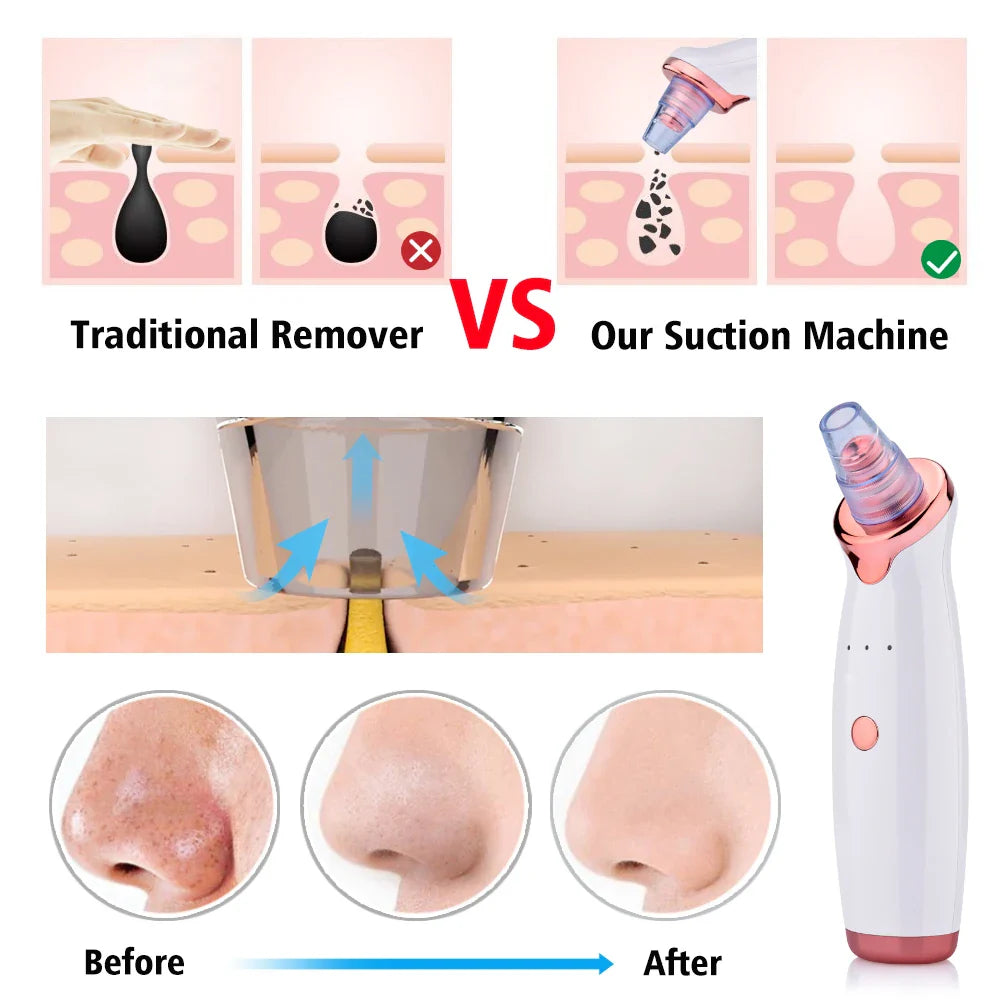 Povei Blackhead Remover Vacuum for Deep Cleaning Skin Care through Suction