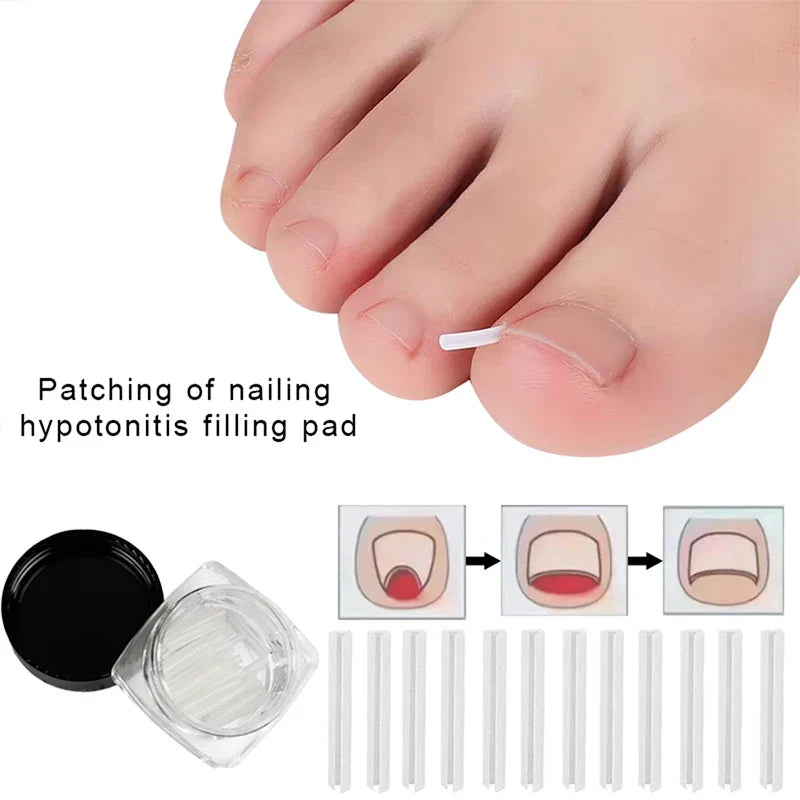 Povei Ingrown Toenail Correction Kit: Sticker, Clip, Brace Pedicure Tool