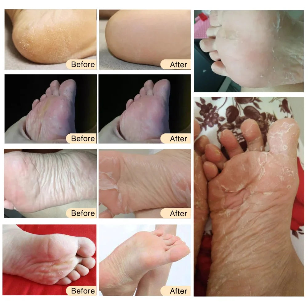 Povei Exfoliating Foot Mask for Soft Feet and Eliminating Dead Skin