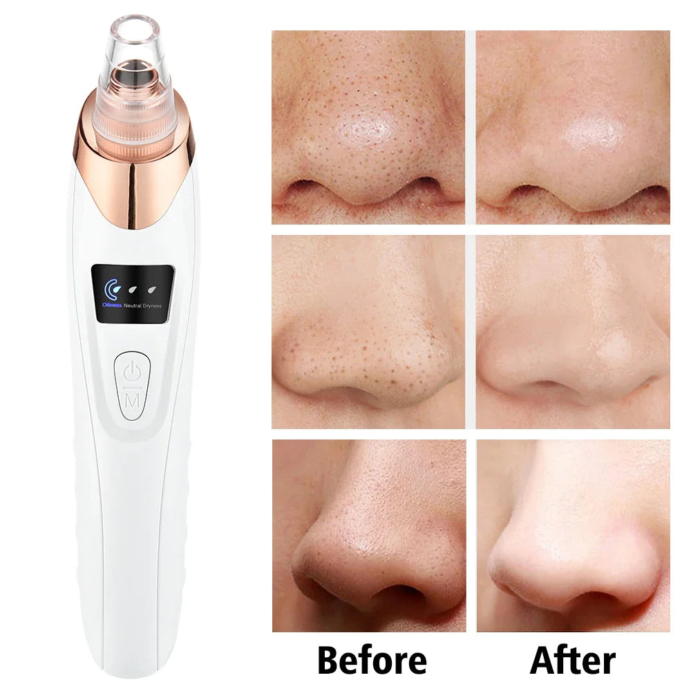 Povei Electric Blackhead Remover Vacuum for Deep Facial Pore Cleansing