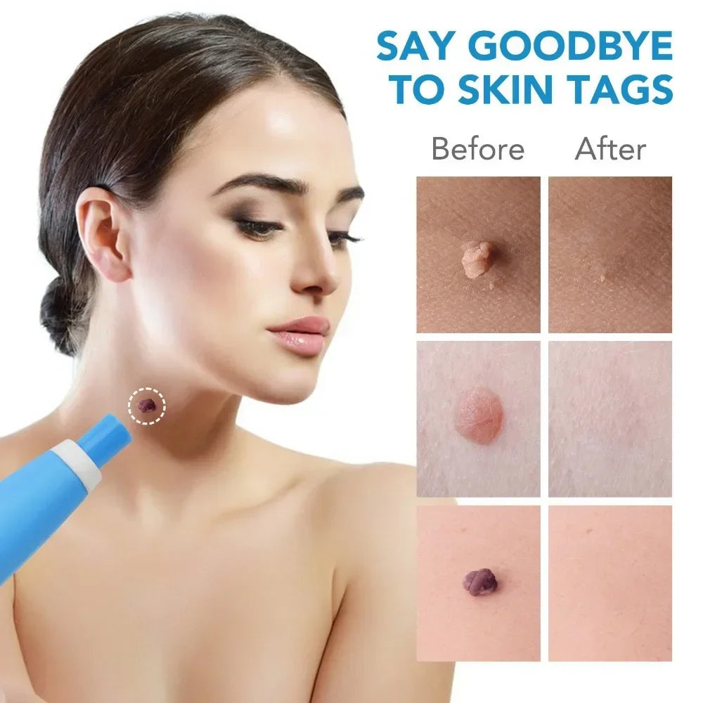 Povei Auto Skin Tag Mole Wart Removal Kit for Face & Body Skin Care