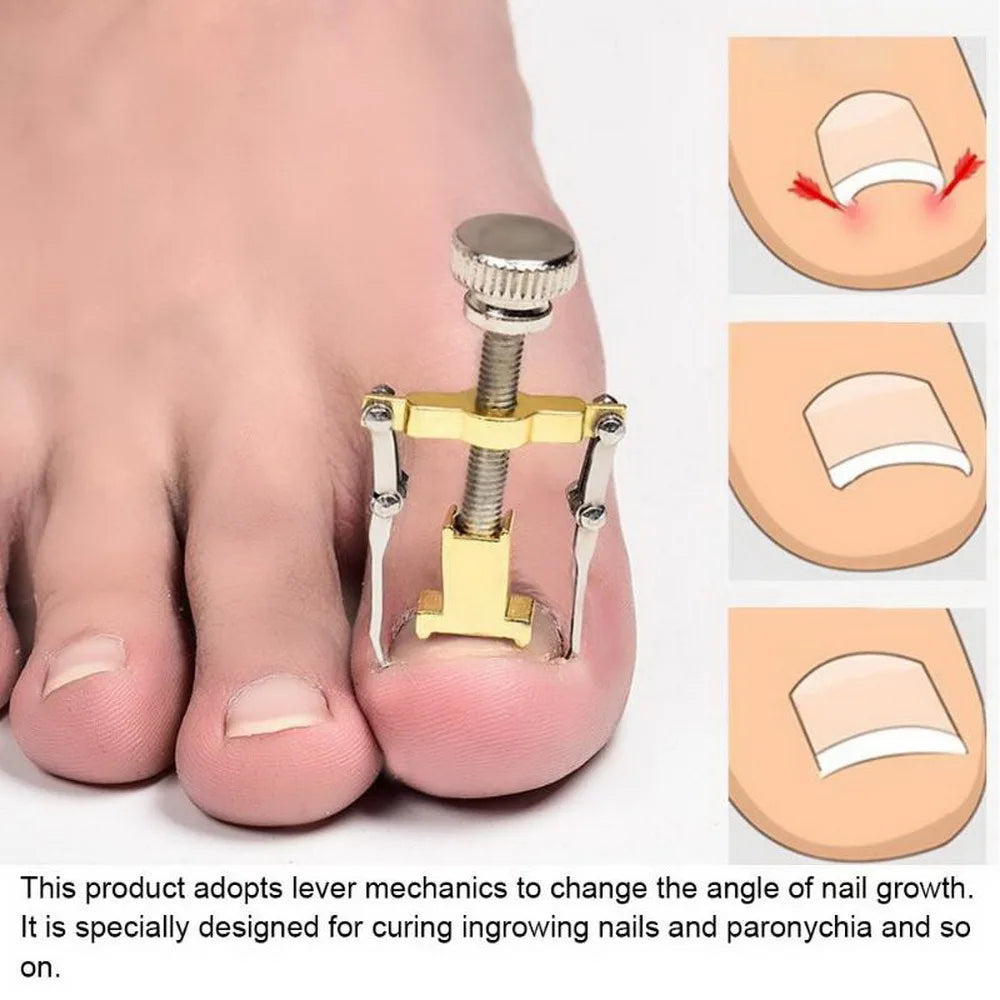 Povei Ingrown Toe Nail Corrector Tool: Orthotic Pedicure Fixer for Foot Nail Care