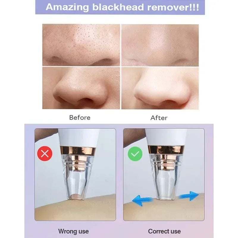 Povei Electric Blackhead Remover Vacuum for Pore Cleaning and Acne Treatment