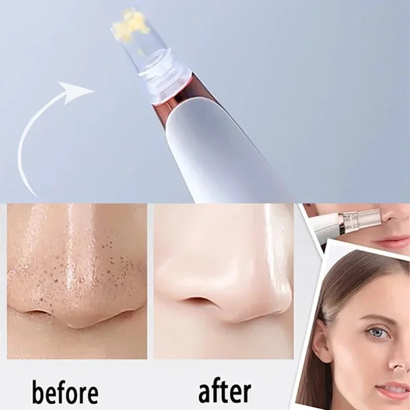 Povei Electric Blackhead Remover Vacuum for Pore Cleaning and Acne Treatment