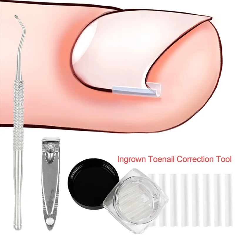 Povei Ingrown Toenail Correction Kit: Sticker, Clip, Brace Pedicure Tool