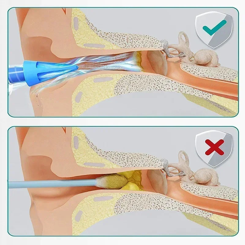 Povei Ear Care Kit: Unique Ear Wax Removal Tool Syringe for Clean and Comfortable Irrigation